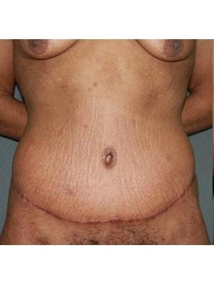 Scot Bradley Glasberg, MD body contouring after — New York, NY