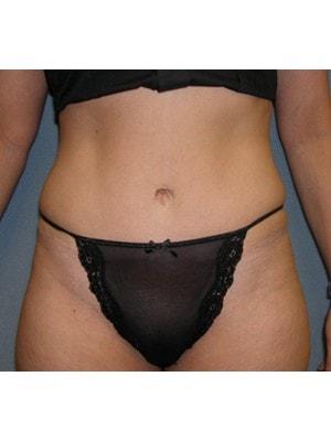 Scot Bradley Glasberg, MD tummy tuck after — New York, NY