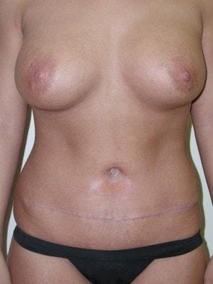 Scot Bradley Glasberg, MD mommy makeover after — New York, NY