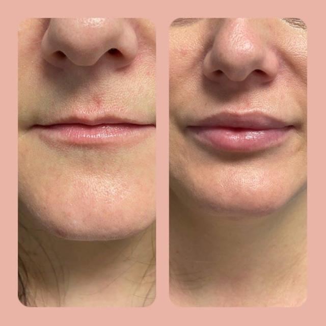 Lip Filler result at Tseng Plastic Surgery in Bellevue, WA