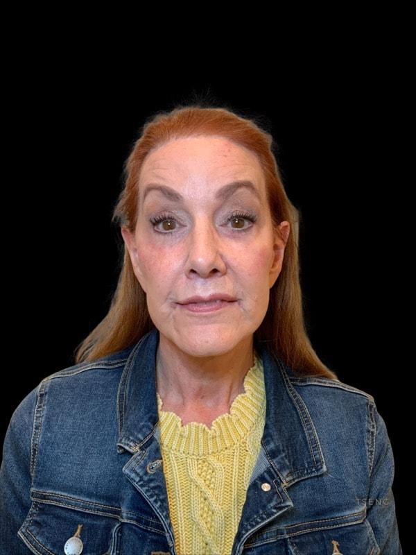 Tseng Plastic Surgery facelift after — Bellevue, WA