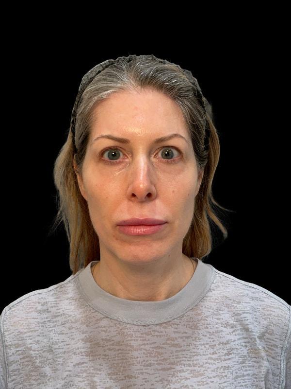 Tseng Plastic Surgery fat transfer after — Bellevue, WA