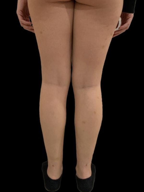 Tseng Plastic Surgery liposuction after — Bellevue, WA