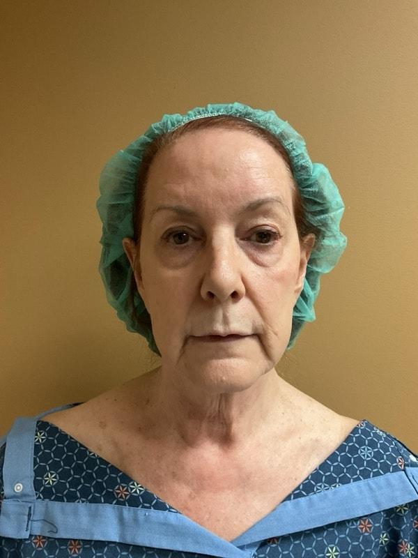 Deep Plane Facelift before at Tseng Plastic Surgery in Bellevue, WA