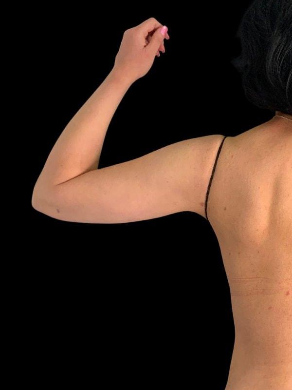 Tseng Plastic Surgery liposuction after — Bellevue, WA