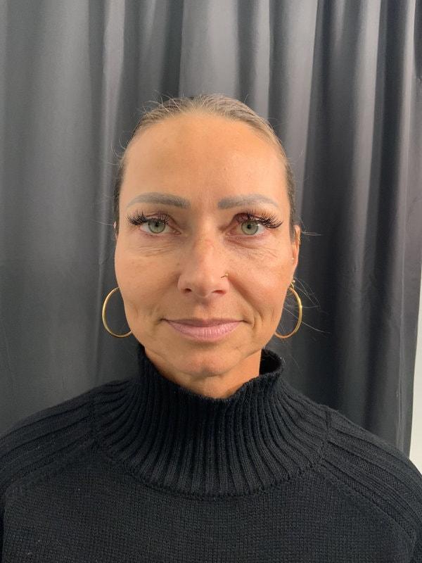 Blepharoplasty before at Tseng Plastic Surgery in Bellevue, WA