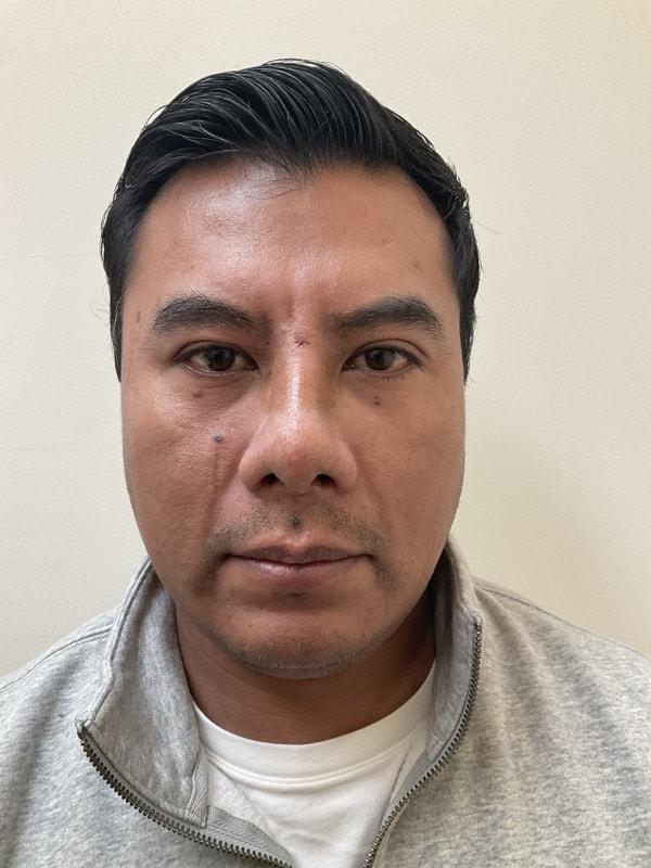 Rhinoplasty after at Tseng Plastic Surgery in Bellevue, WA