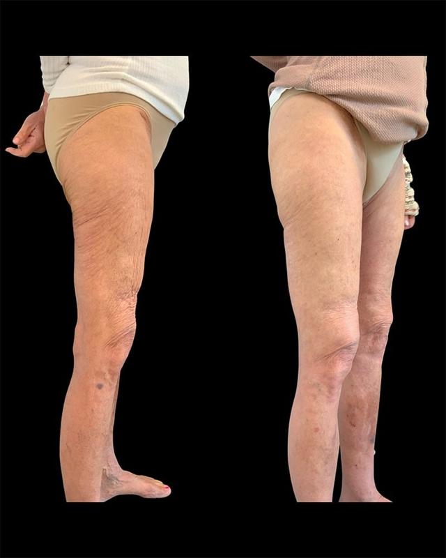 Thigh Lift after at Tseng Plastic Surgery in Bellevue, WA