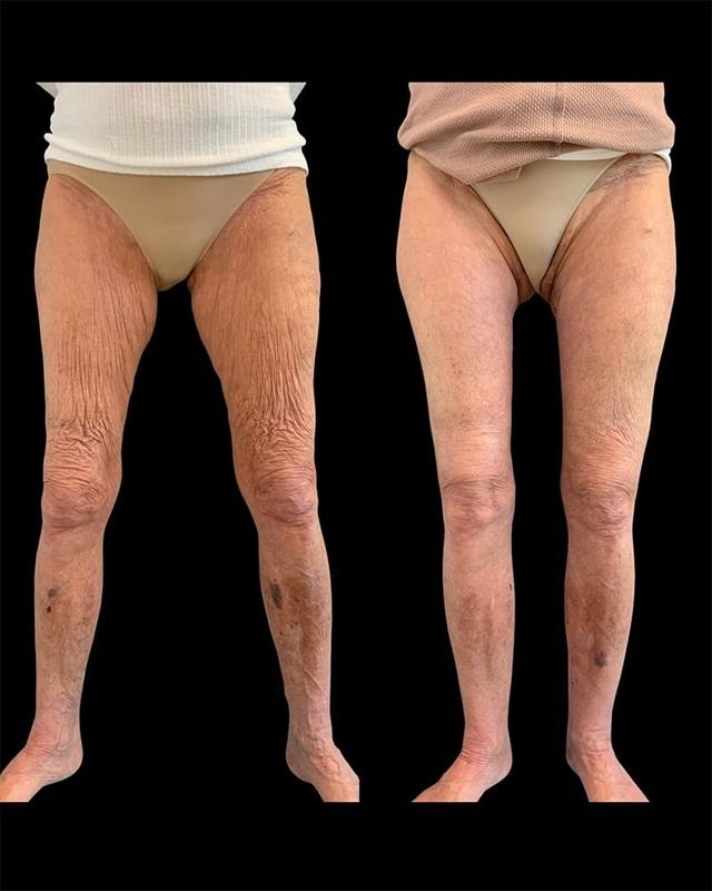 Thigh Lift before at Tseng Plastic Surgery in Bellevue, WA
