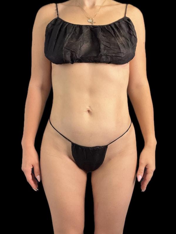 Tseng Plastic Surgery liposuction after — Bellevue, WA