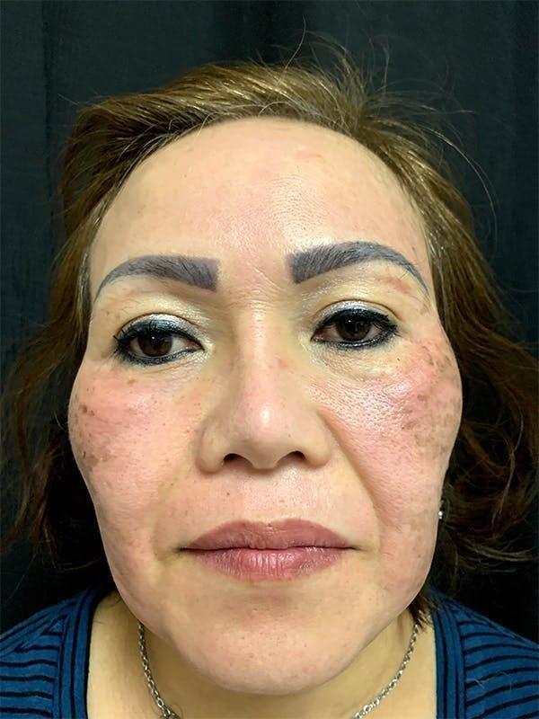 Laser Skin Resurfacing before at Tseng Plastic Surgery in Bellevue, WA