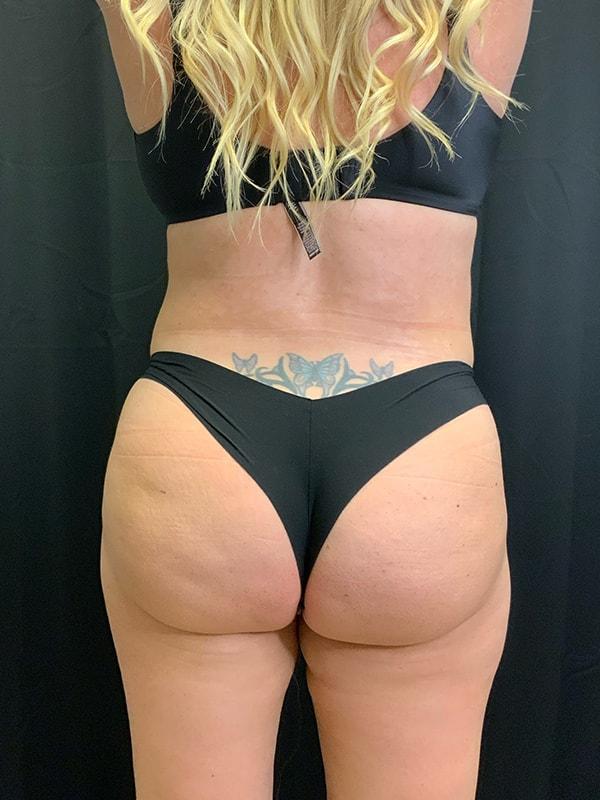 Brazilian Butt Lift after at Tseng Plastic Surgery in Bellevue, WA