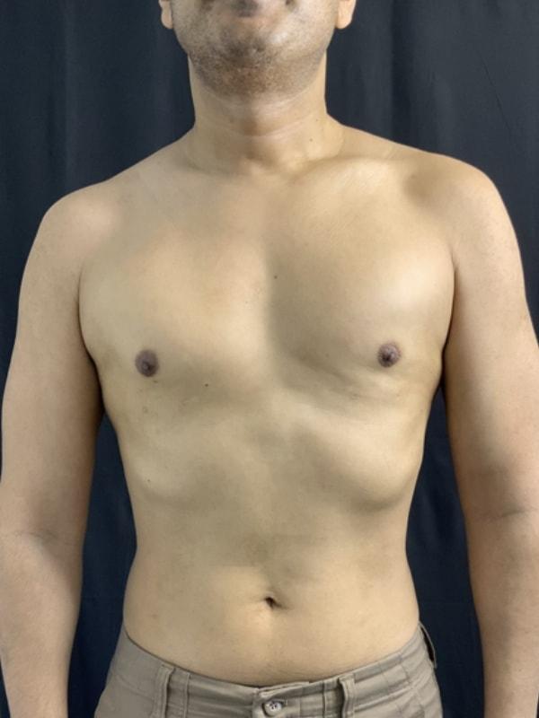 Gynecomastia Surgery after at Tseng Plastic Surgery in Bellevue, WA