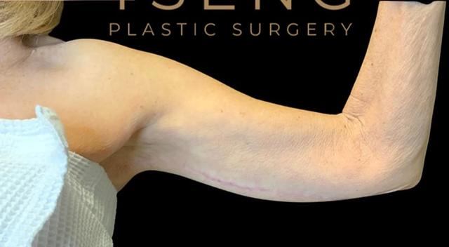 Arm Lift after at Tseng Plastic Surgery in Bellevue, WA