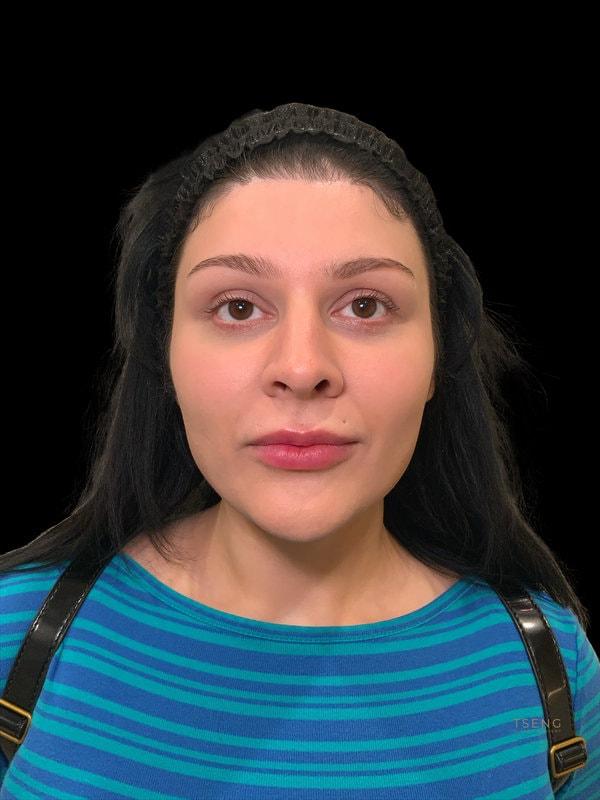 Tseng Plastic Surgery fat transfer after — Bellevue, WA