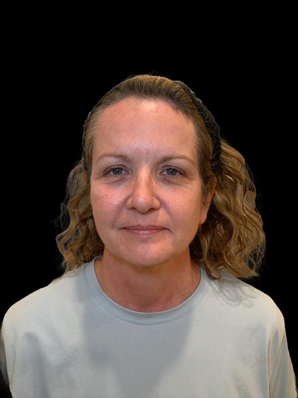Tseng Plastic Surgery facelift after — Bellevue, WA