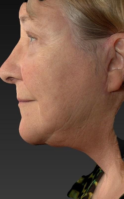 Tseng Plastic Surgery facelift after — Bellevue, WA