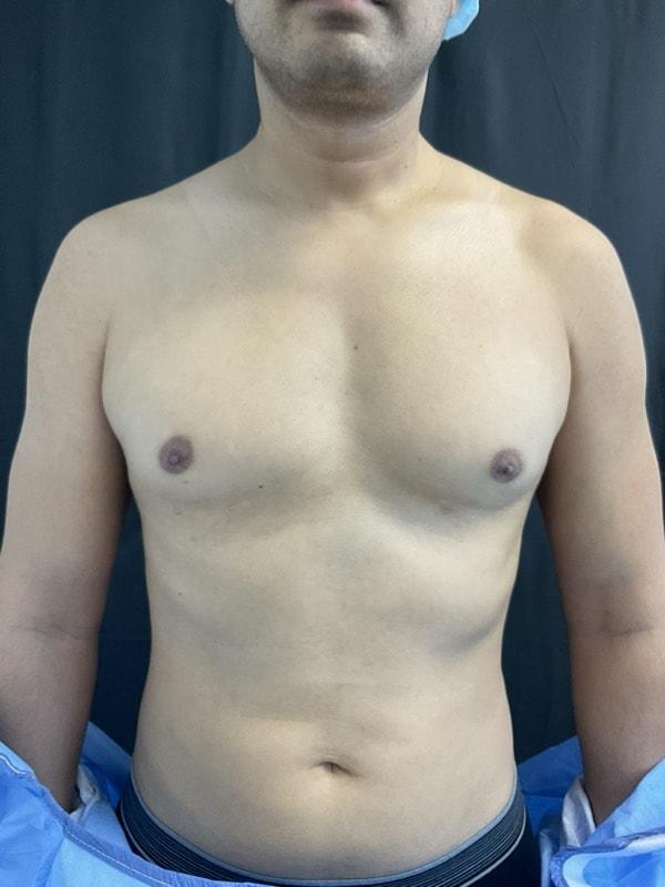 Gynecomastia Surgery before at Tseng Plastic Surgery in Bellevue, WA