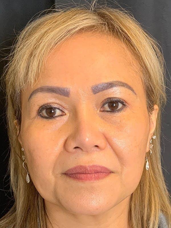 Laser Skin Resurfacing after at Tseng Plastic Surgery in Bellevue, WA