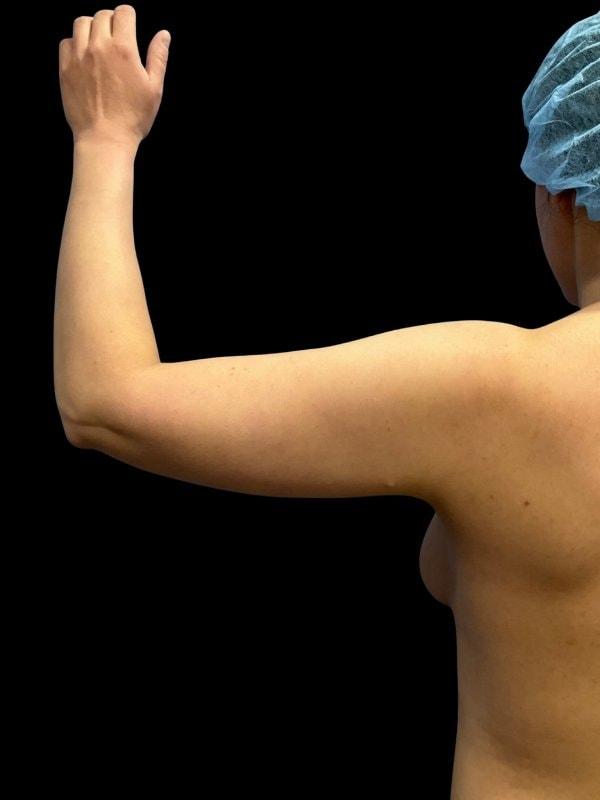 Liposuction before at Tseng Plastic Surgery in Bellevue, WA