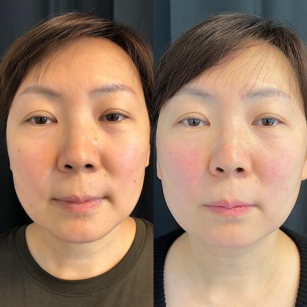 Laser Skin Resurfacing result at Tseng Plastic Surgery in Bellevue, WA
