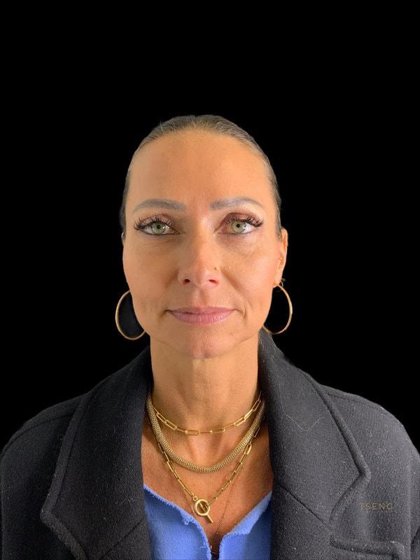 Blepharoplasty after at Tseng Plastic Surgery in Bellevue, WA