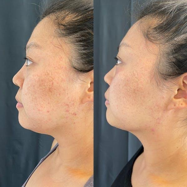 Laser Skin Resurfacing result at Tseng Plastic Surgery in Bellevue, WA