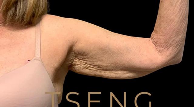 Arm Lift before at Tseng Plastic Surgery in Bellevue, WA