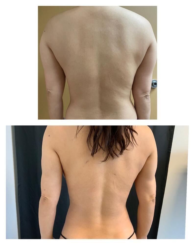 Tseng Plastic Surgery liposuction after — Bellevue, WA