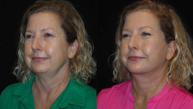 Revel You Facial Plastic Surgery result — The Woodlands, TX