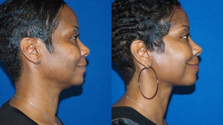 Revel You Facial Plastic Surgery facelift result — The Woodlands, TX