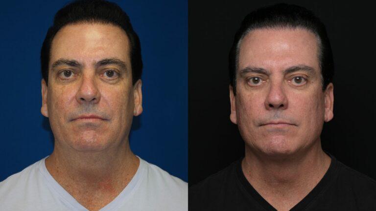 Revel You Facial Plastic Surgery result — The Woodlands, TX