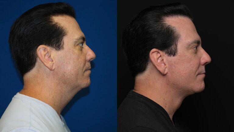 Revel You Facial Plastic Surgery result — The Woodlands, TX