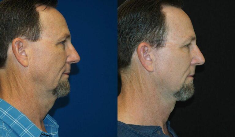 Revel You Facial Plastic Surgery result — The Woodlands, TX
