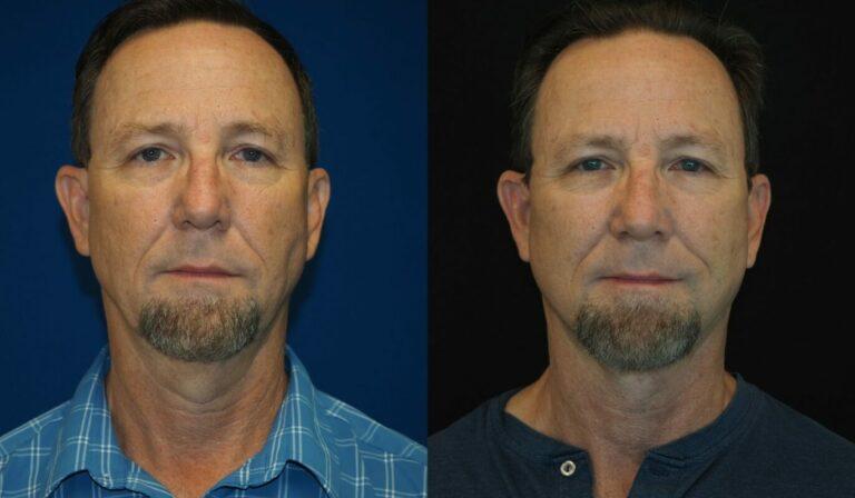 Revel You Facial Plastic Surgery result — The Woodlands, TX