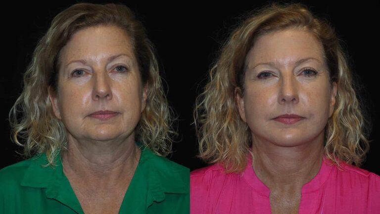 Revel You Facial Plastic Surgery result — The Woodlands, TX