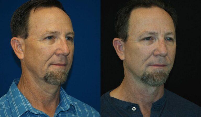 Revel You Facial Plastic Surgery result — The Woodlands, TX