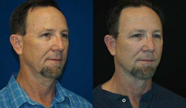 Facelift result at Revel You Facial Plastic Surgery in The Woodlands, TX