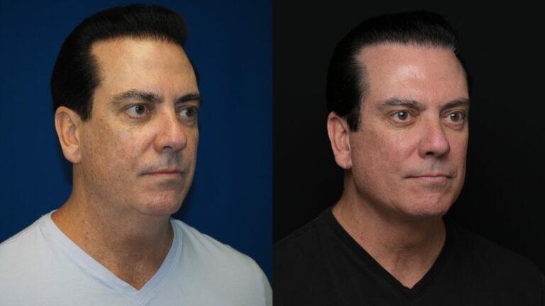 Revel You Facial Plastic Surgery result — The Woodlands, TX