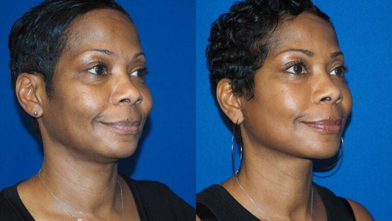 Revel You Facial Plastic Surgery facelift result — The Woodlands, TX