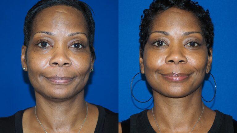 Revel You Facial Plastic Surgery facelift result — The Woodlands, TX