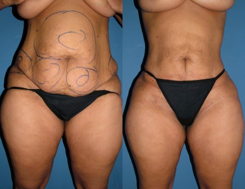 Nowak Aesthetics liposuction result — Chula Vista, CA