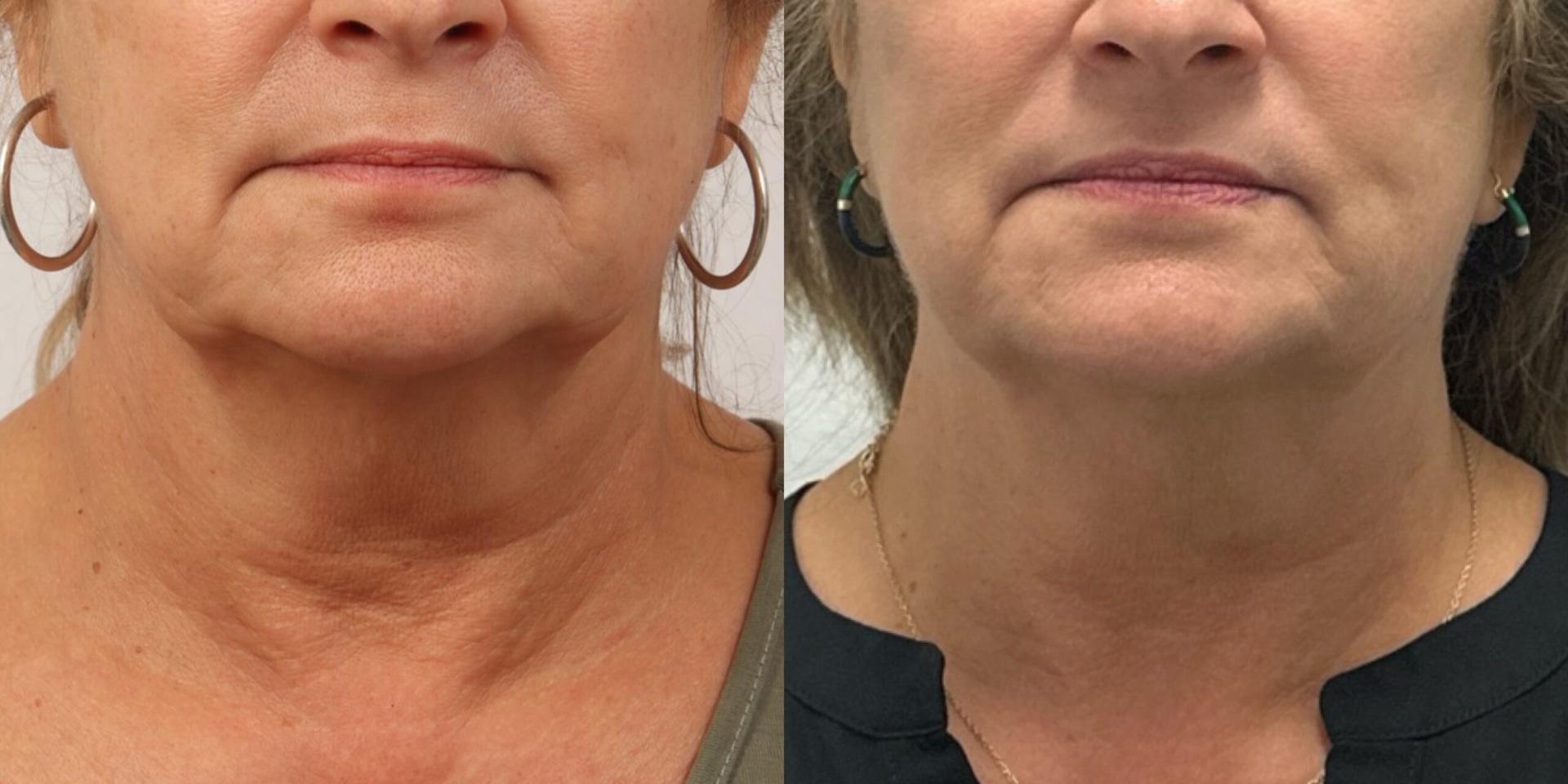Nowak Aesthetics morpheus8 result — Chula Vista, CA