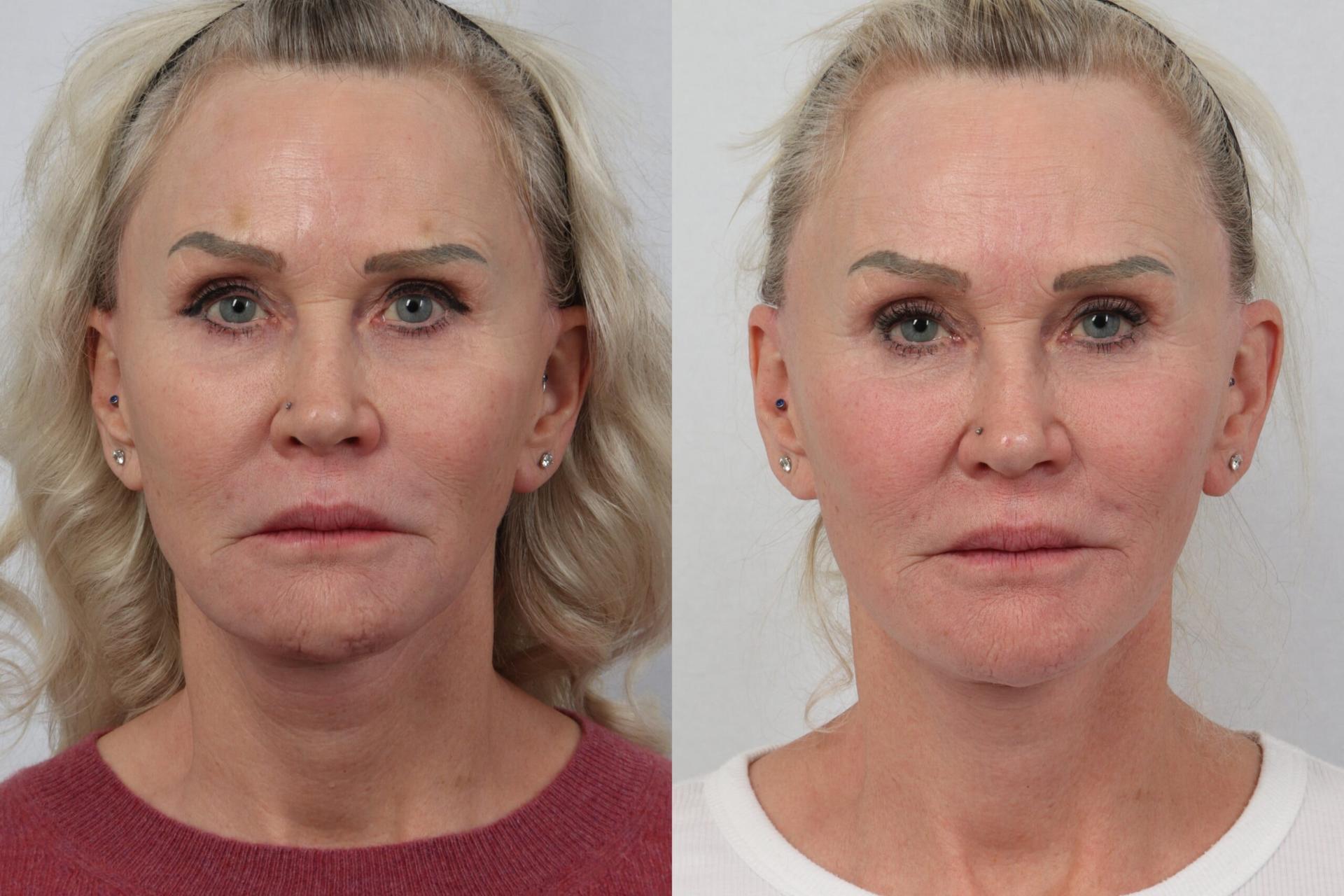 Nowak Aesthetics skin tightening result — Chula Vista, CA