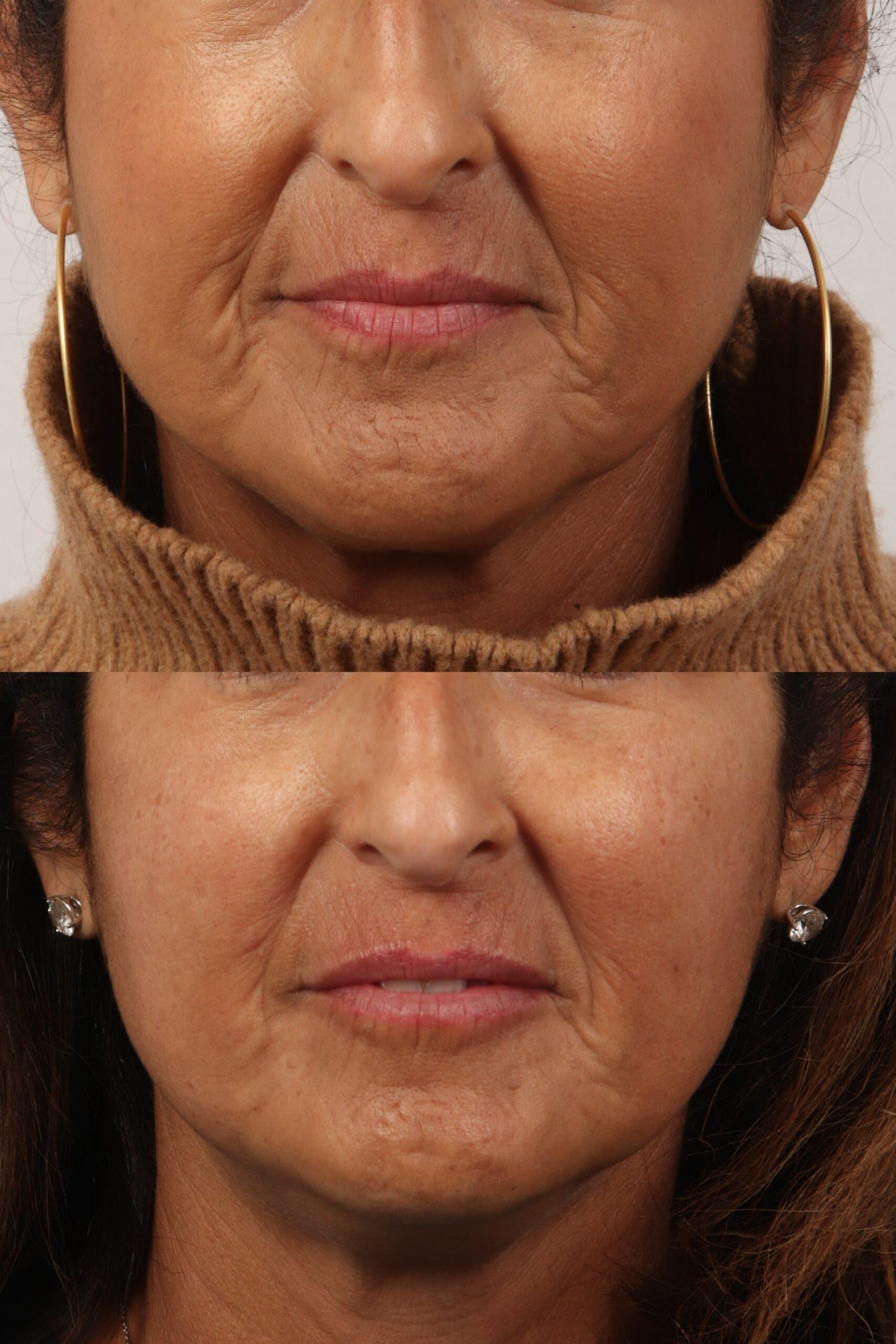 Nowak Aesthetics skin tightening result — Chula Vista, CA