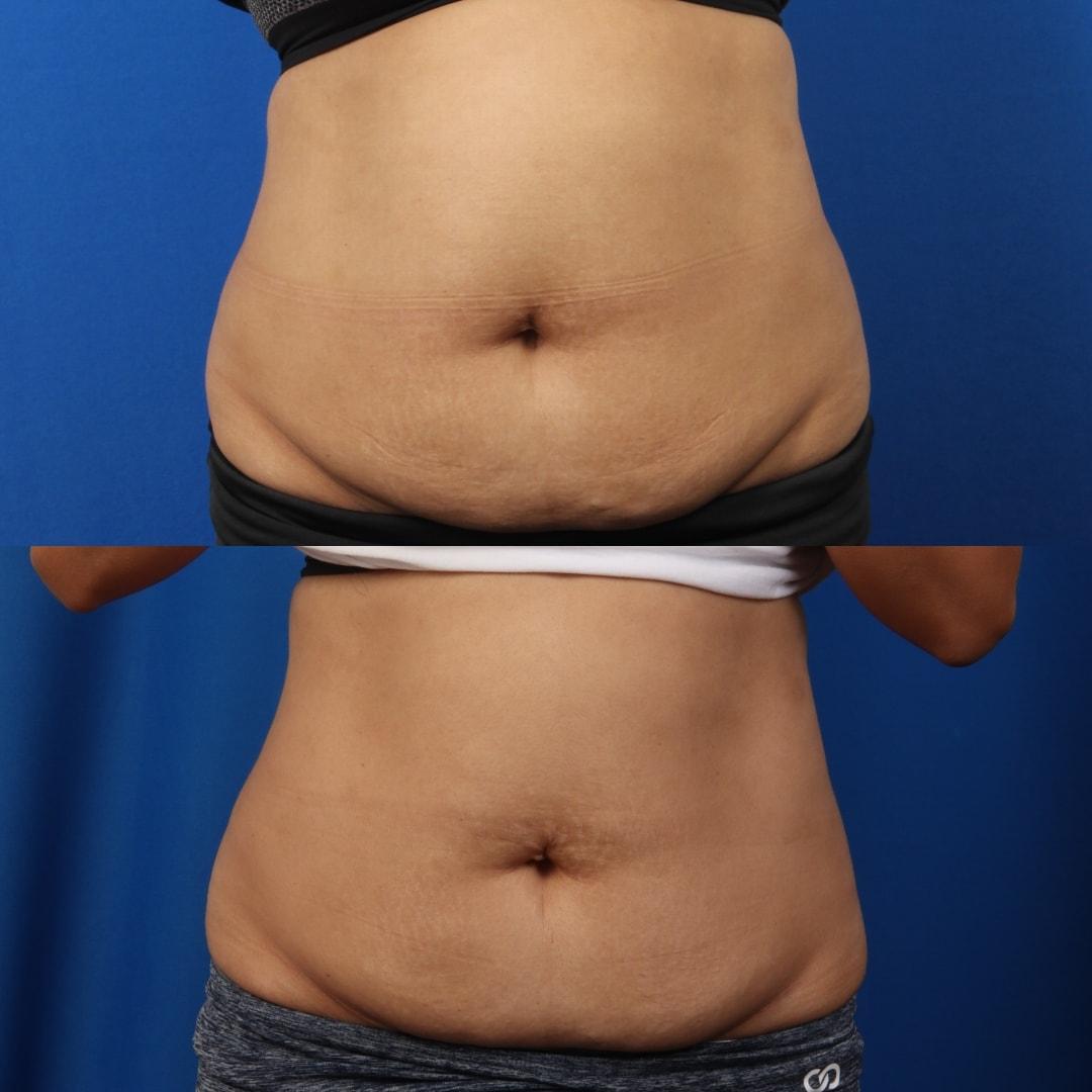 Nowak Aesthetics emsculpt result — Chula Vista, CA
