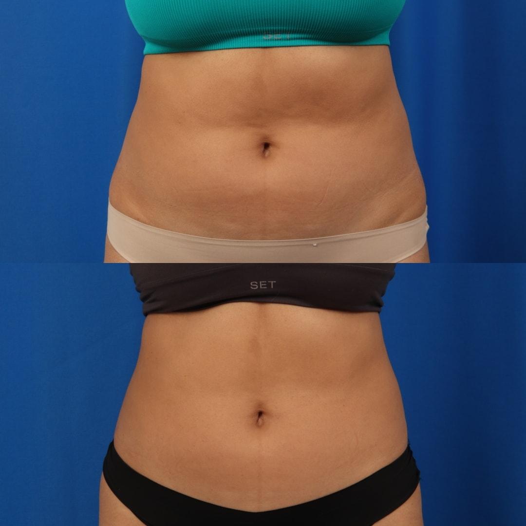 Nowak Aesthetics emsculpt result — Chula Vista, CA