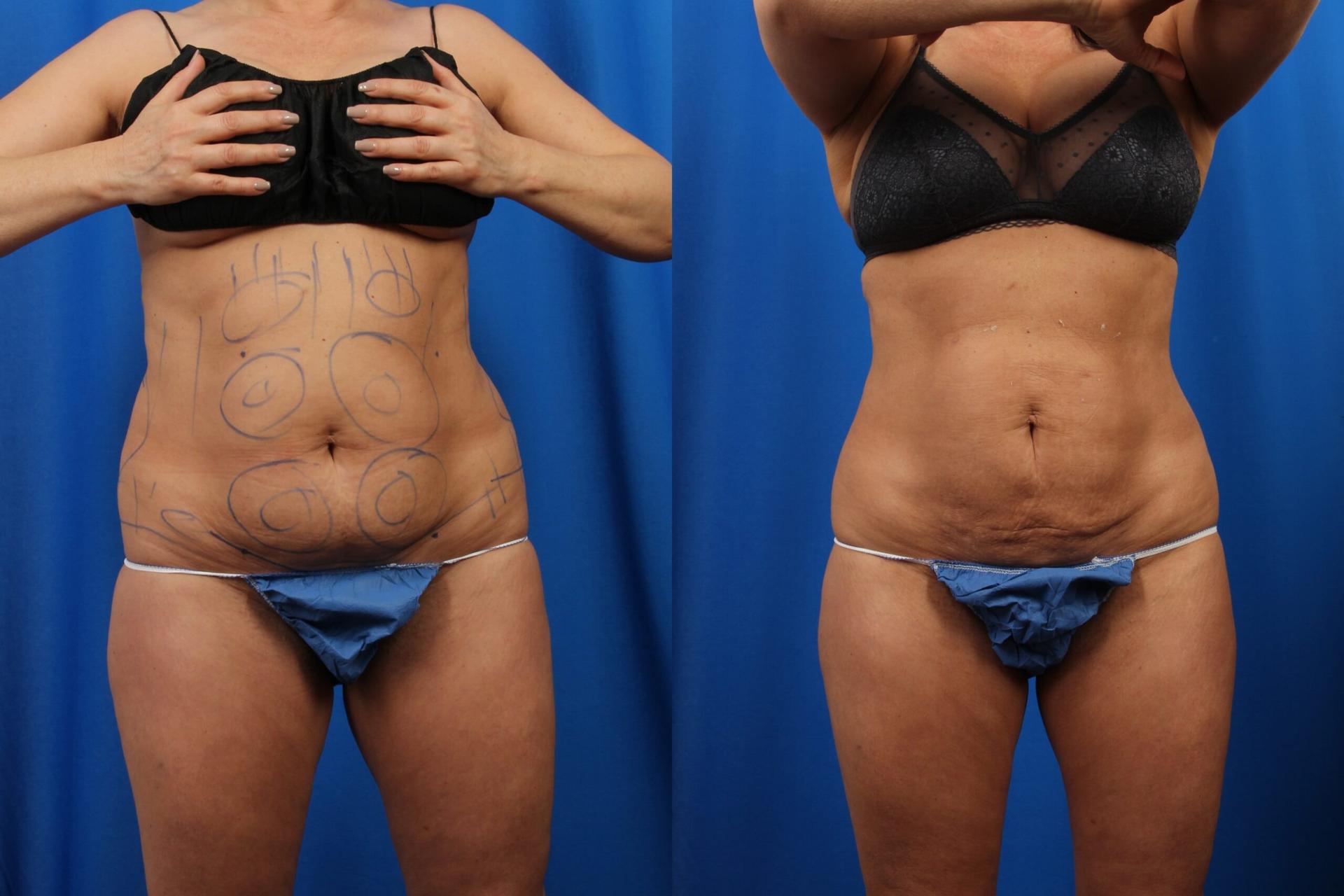 Nowak Aesthetics liposuction result — Chula Vista, CA