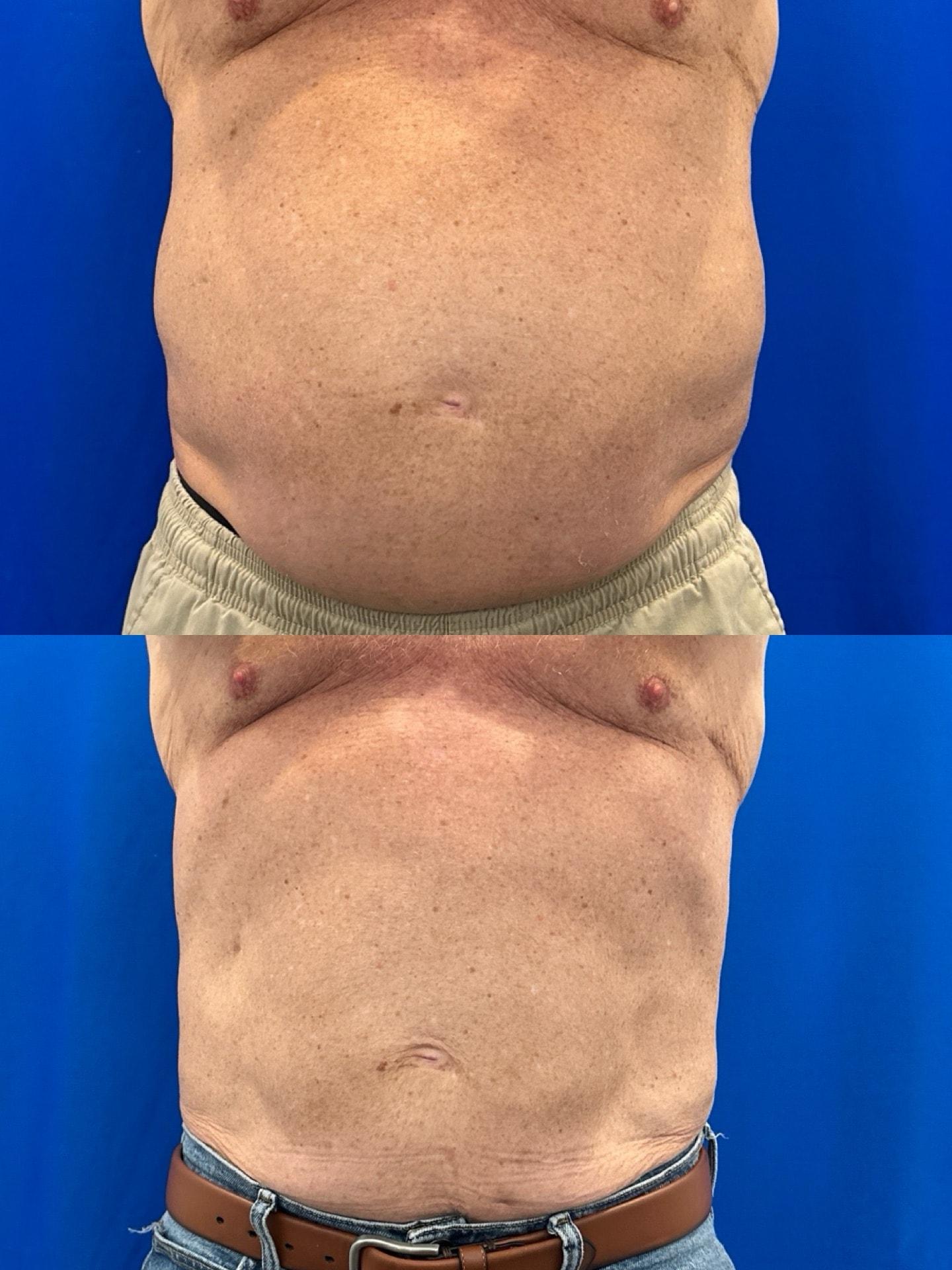 Nowak Aesthetics emsculpt result — Chula Vista, CA