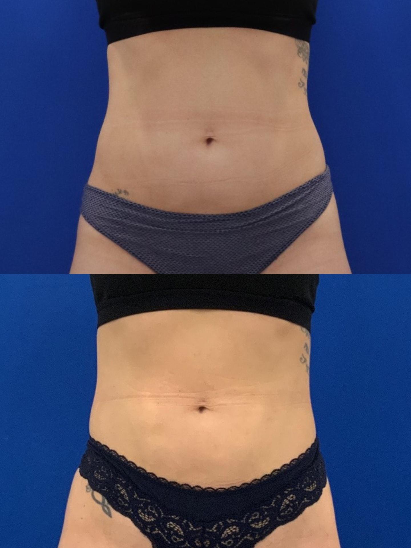 Nowak Aesthetics emsculpt result — Chula Vista, CA